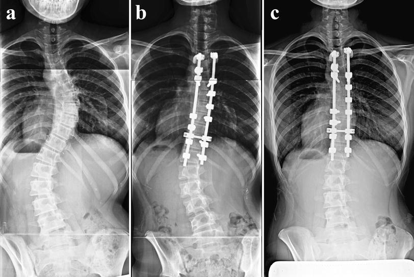 Postoperative behavior of thoracolumbar/lumbar curve and coronal
