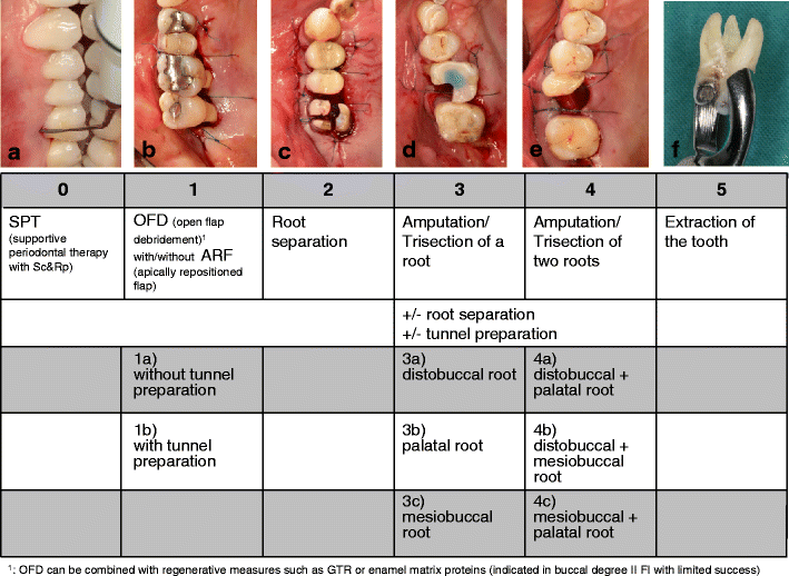Periodontal surgery in furcation-involved maxillary molars revisited—an