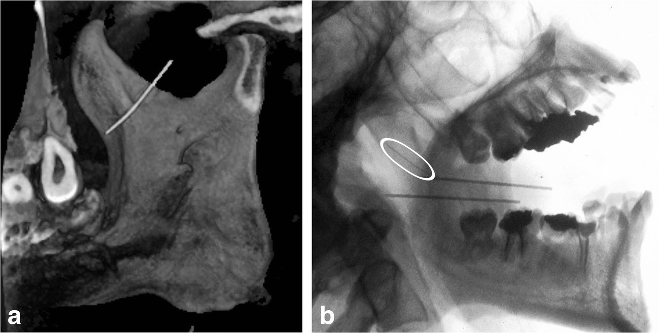 Needle fracture as a complication of dental local anesthesia