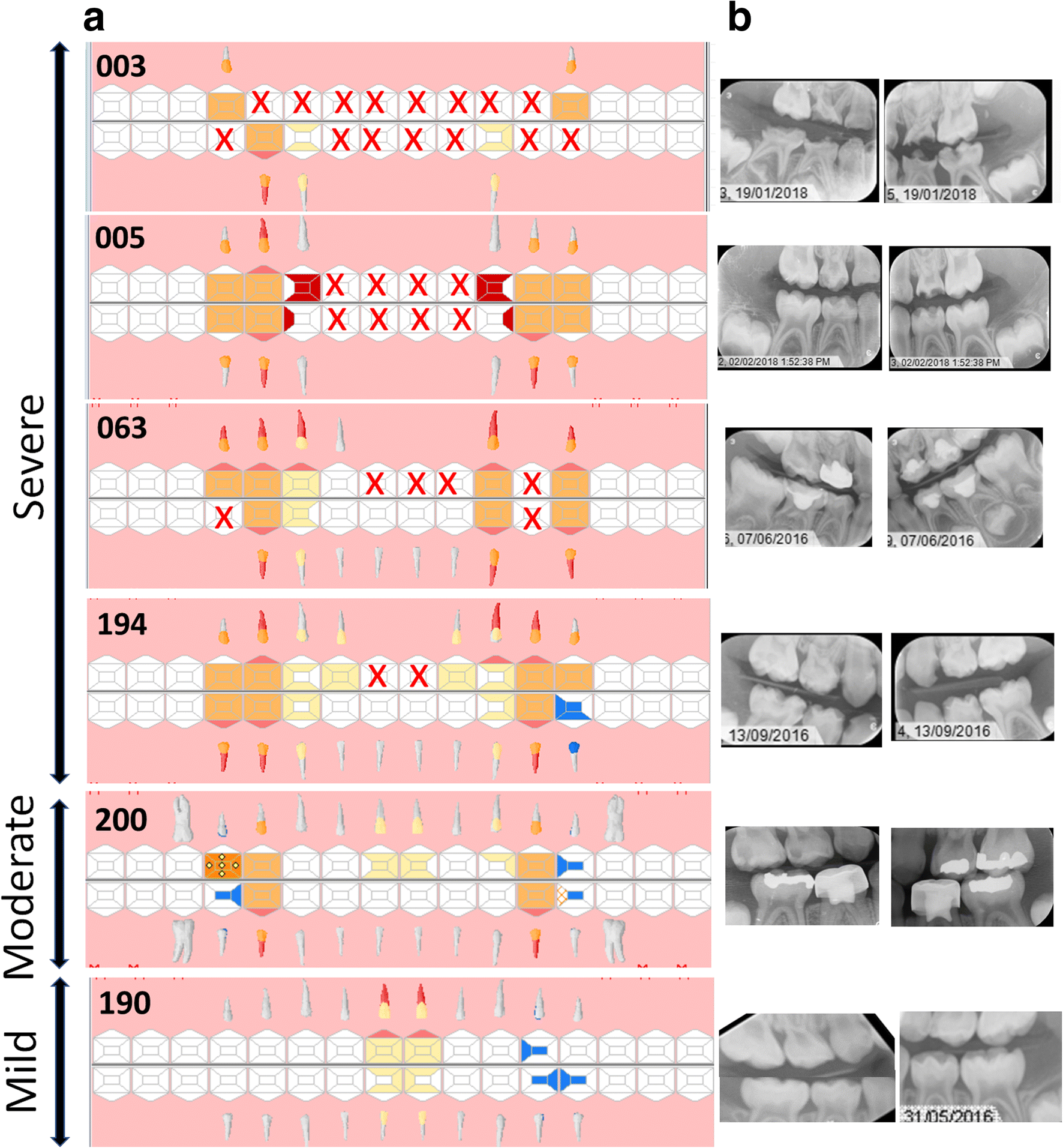 Association Of Streptococcus Mutans Collagen Binding Genes With