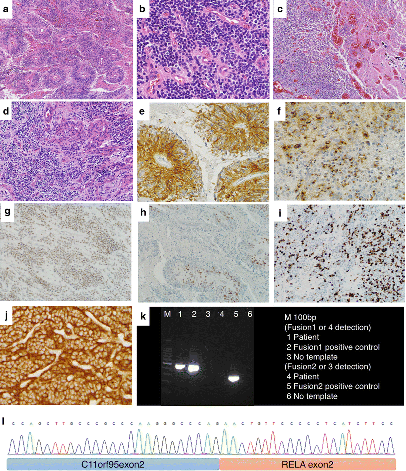 picture Clear Cell Ependymoma Pathology Outlines pathology outlines rela fusion