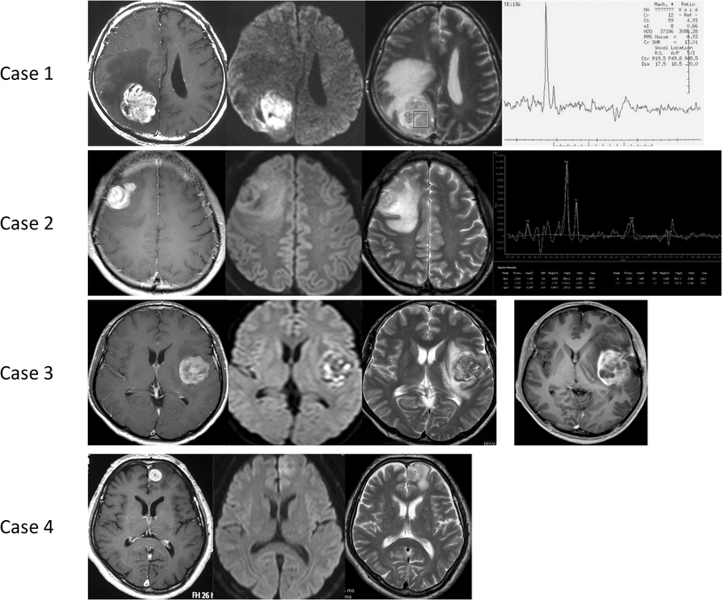 Glioblastoma In Neurofibromatosis 1 Patients Without Idh1
