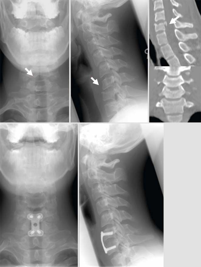 Standarddiagnostik Und Management Von Subaxialen HWS-Verletzungen ...