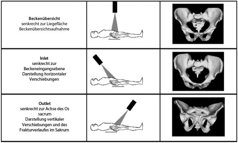 Ala Und Obturatoraufnahme , Periprothetische Acetabulumfrakturen – GZVZU
