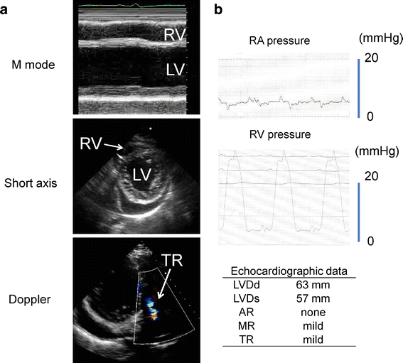 A case of lateonset right ventricular failure after implantation of a