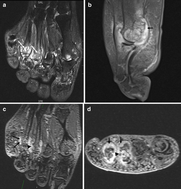 MRI identifies plantar plate pathology in the forefoot of patients with