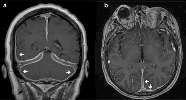 Pachymeningitis In Granulomatosis With Polyangiitis Case Series With