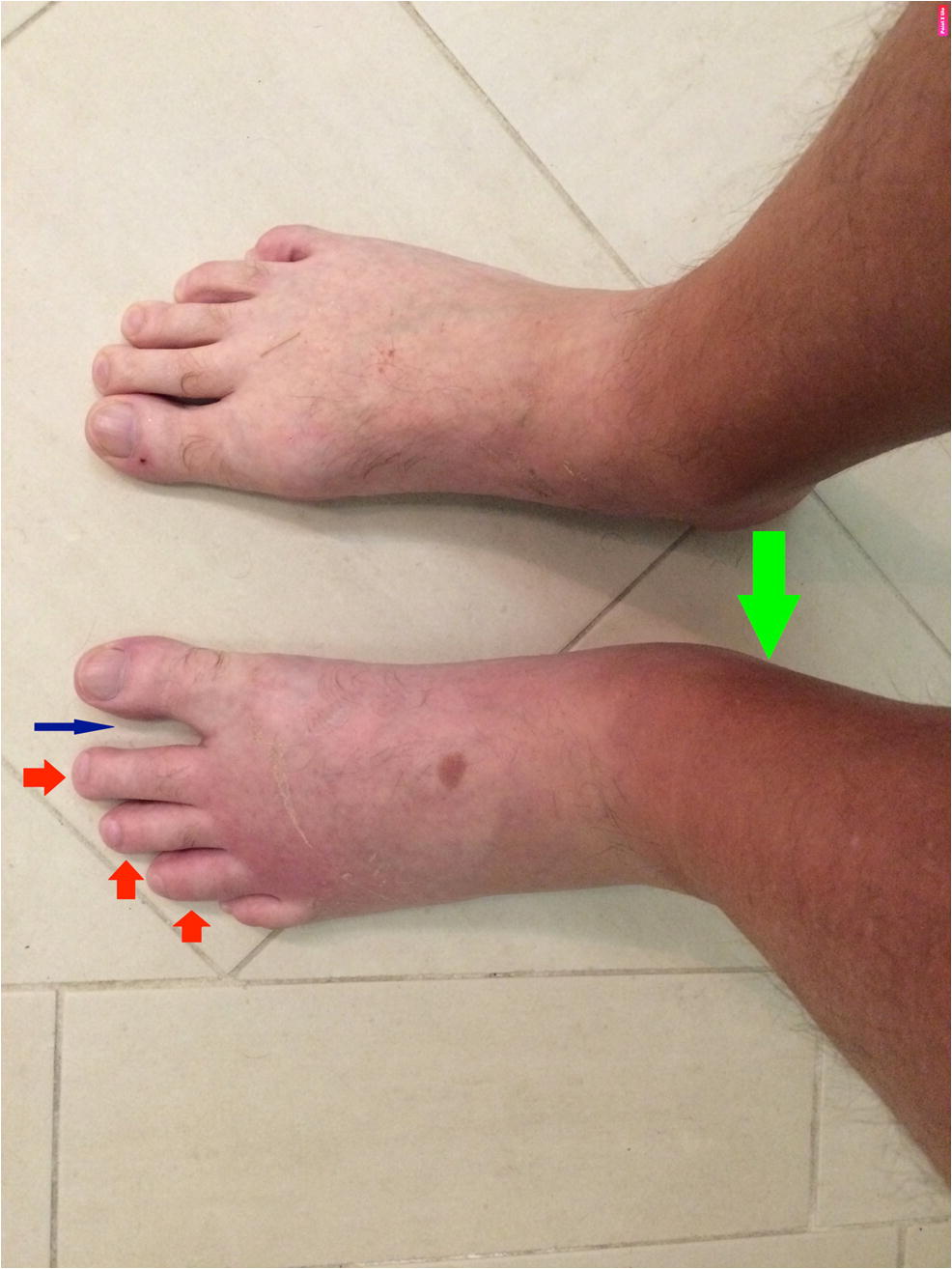 Trauma Induced Concomitant Psoriatic Arthritis And Complex Regional