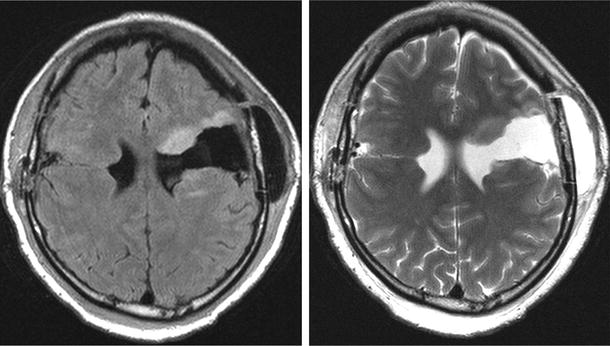 Successful Surgery For Refractory Seizures Associated With