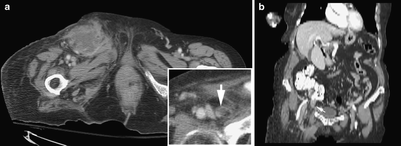 Ct Findings Of Normal And Inflamed Appendix In Groin Hernia Springerlink