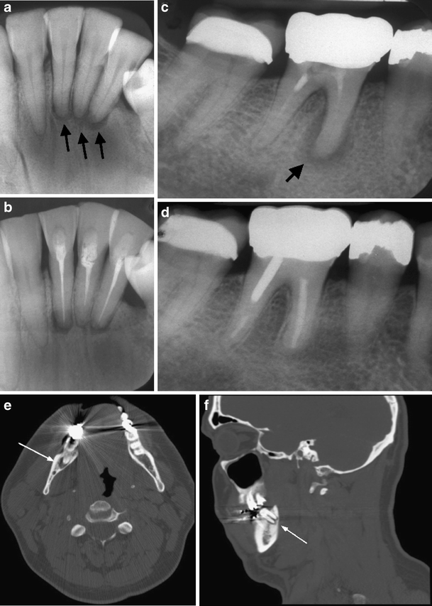 Cemento-osseous dysplasia, a radiological mimic of periapical dental ...