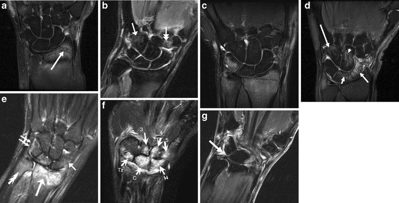 occult fracture occult fracture