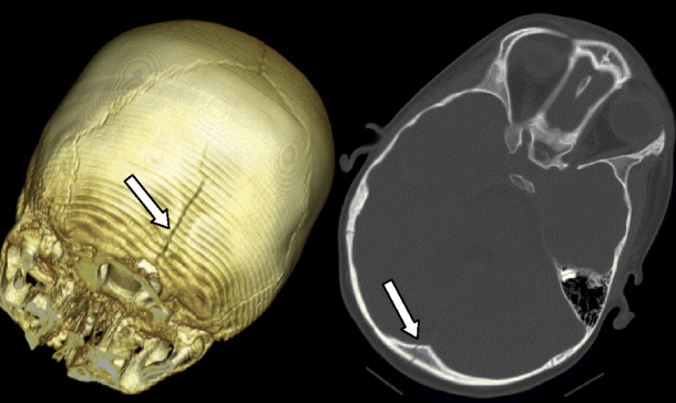 forehead skull fracture forehead skull fracture