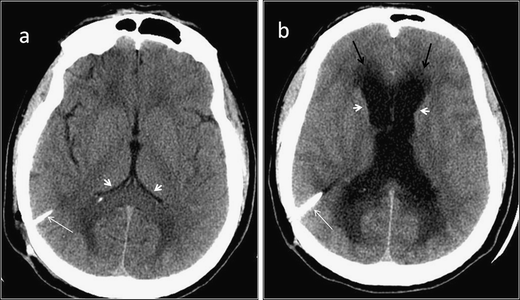 Detection of ventricular shunt malfunction in the ED: relative utility ...