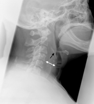 Analysing lateral soft tissue neck radiographs | SpringerLink