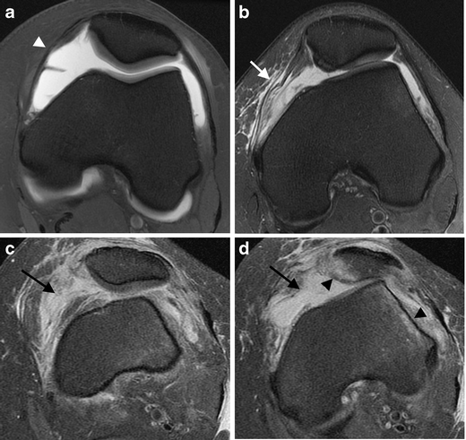 Transient lateral patellar dislocation: review of imaging findings