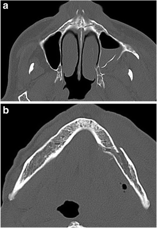 Fractures of the posterolateral maxillary sinus: a masticator space ...