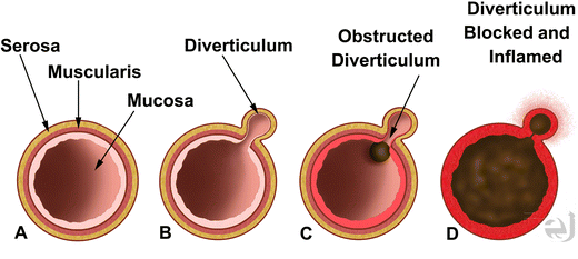 Image result for true vs false diverticulum
