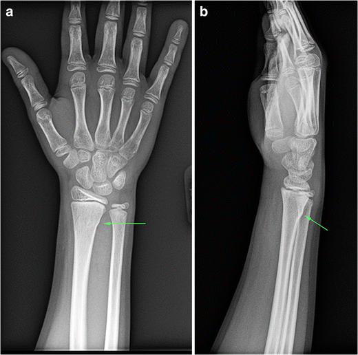 Core curriculum illustration pediatric buckle fracture of