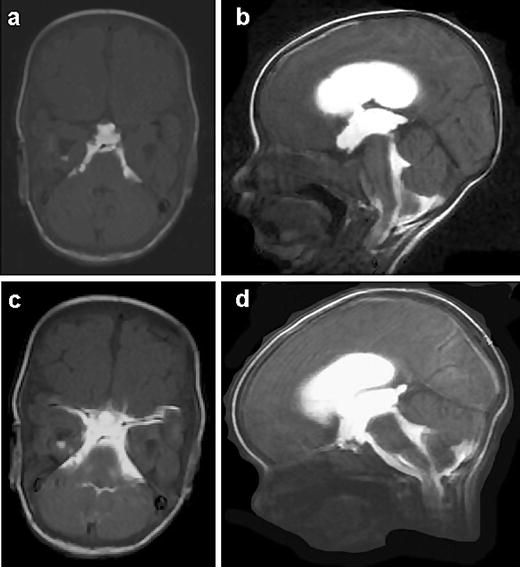 Role of endoscopic third ventriculostomy in patients with communicating