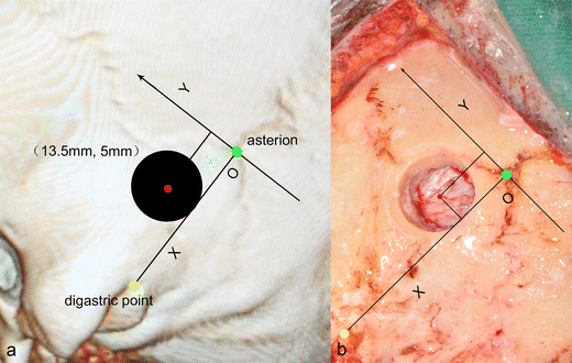 Localization of transverse-sigmoid sinus junction using preoperative 3D
