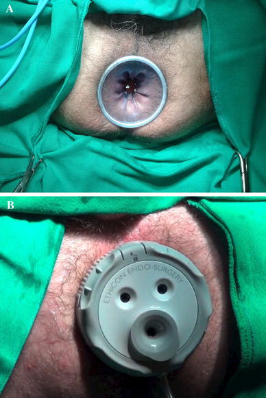 Transanal minimally invasive surgery (TAMIS) using a new disposable