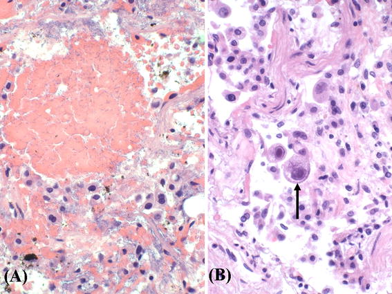 Hydralazine-induced autoimmune disease: comparison to idiopathic lupus ...