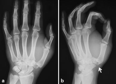 Carpometacarpal Dislocation Of The Thumb Associated With - 