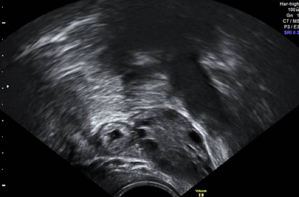 Ultraschall | Gestrte Frhgraviditt | springermedizin.de