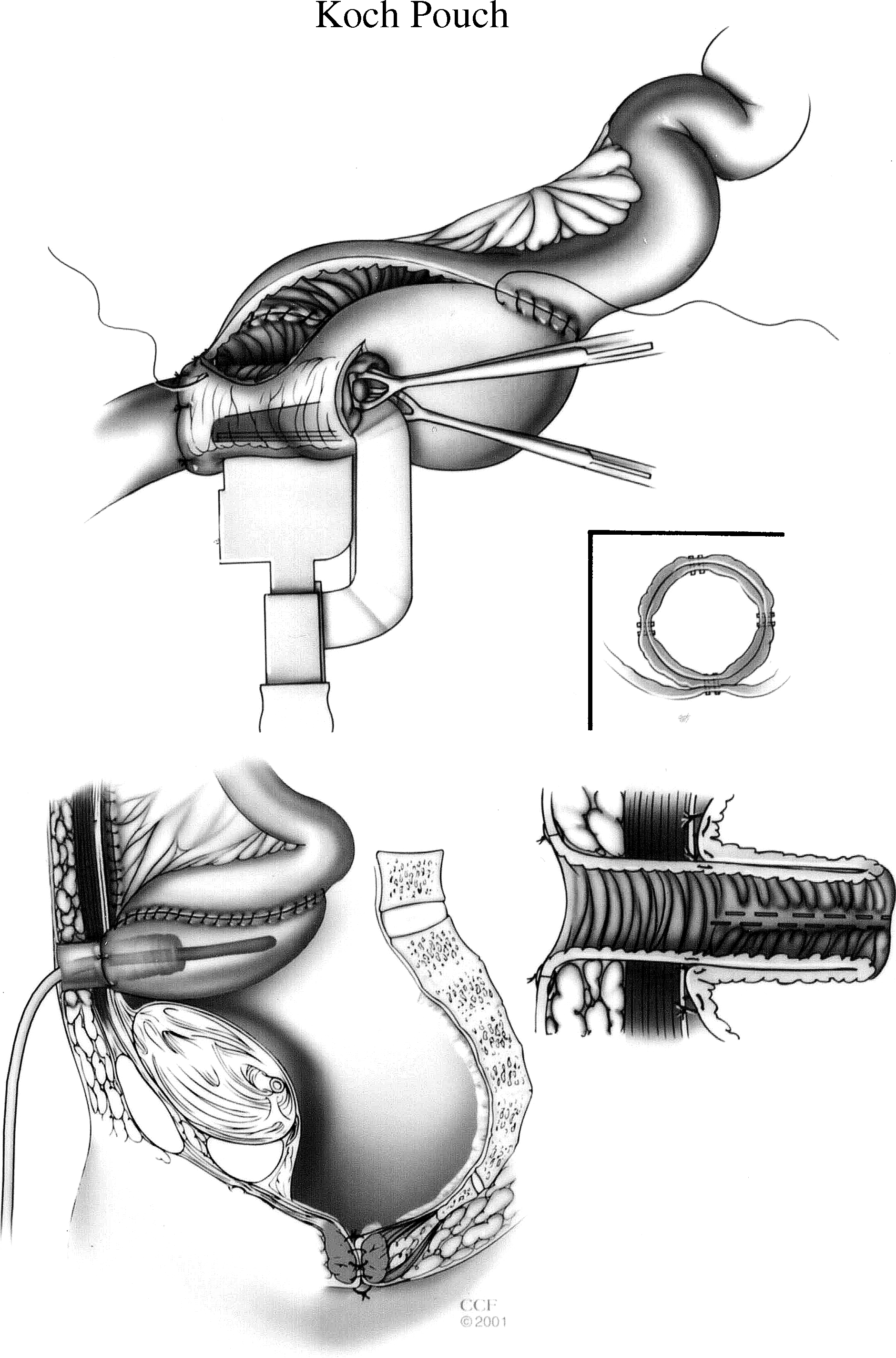 LongTerm and Quality of Life After Continent Ileostomy