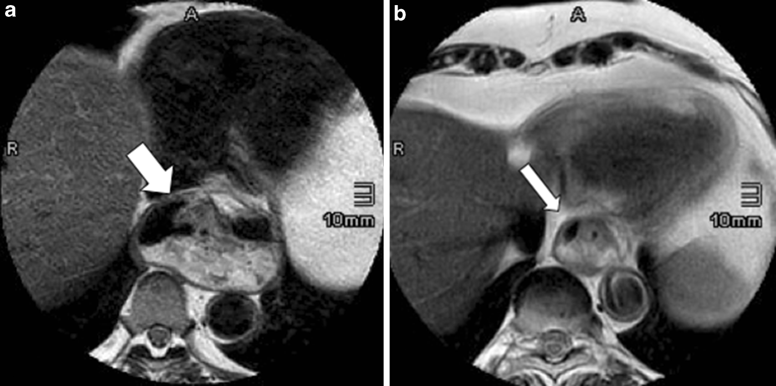 Swallowing Mri For Gerd Diagnosis And Treatment Monitoring swallowing mri for gerd diagnosis and