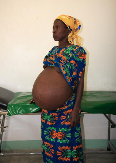 giant ovarian cyst in a woman in rural africa springerlink