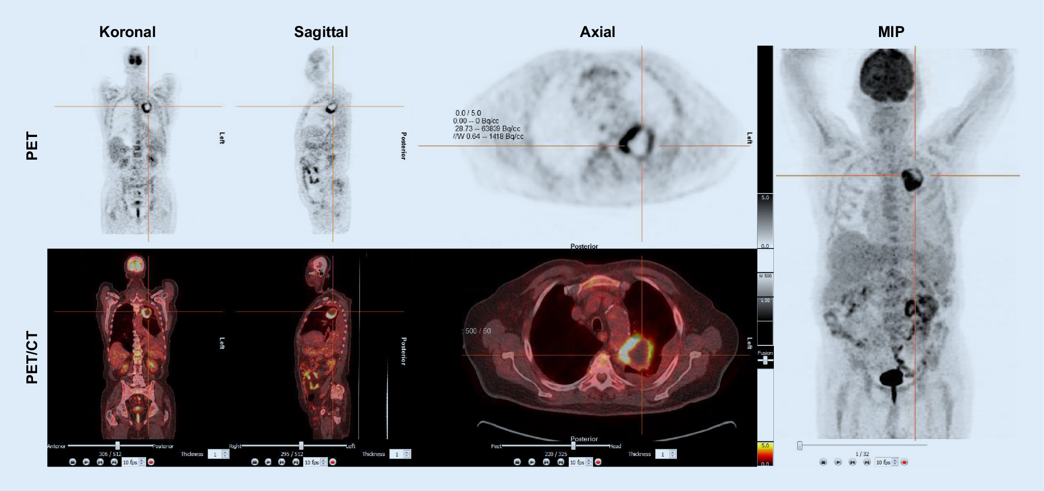 Nuklearmedizinische Diagnostik In Der Pneumologie Springerlink - 