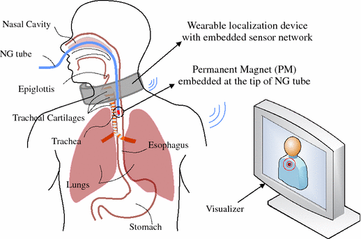 A Non-invasive Real-time Localization System For Enhanced Efficacy In 