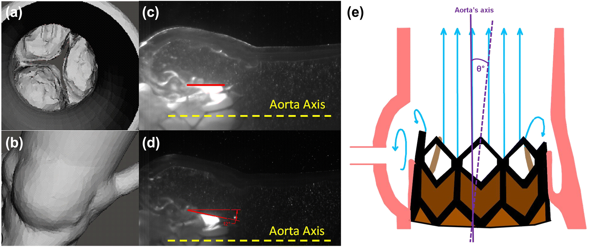 Hemodynamics Variation ... Tilted with Transcatheter Sinus Variation with ... Sinus Transcatheter Hemodynamics Tilted