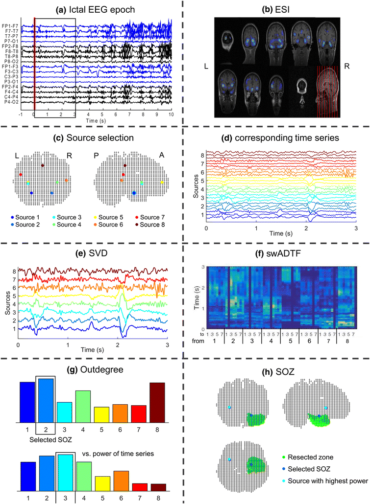 Seizure Onset Zone Localization from Ictal HighDensity EEG in
