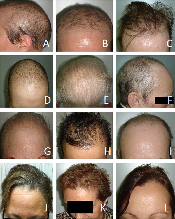 Persistent major alopecia following adjuvant docetaxel for breast