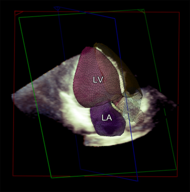 Transthoracic 3D echocardiographic left heart chamber quantification in