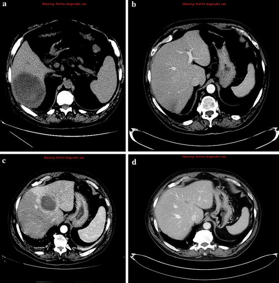 Relapse of Intestinal and Hepatic Amebiasis After Treatment SpringerLink