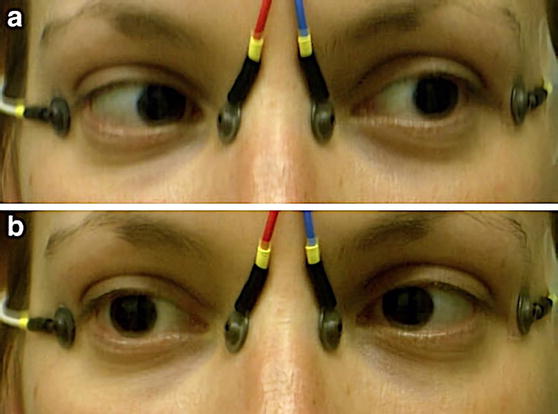 iscev standard for clinical electro oculography 2017 update electro oculography