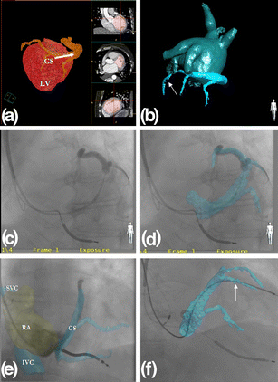 Coronary sinus anatomy by computerized tomography, overlaid on live fluoroscopy can be ...
