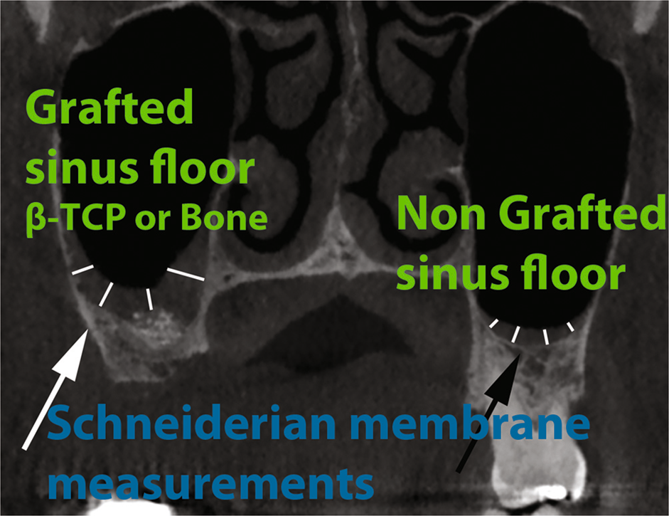 Maxillary Sinus Floor Elevation Using Beta Tricalcium Phosphate