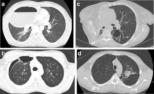 Lung Parenchyma Surgery in Autosomal Dominant Hyper-IgE Syndrome ...