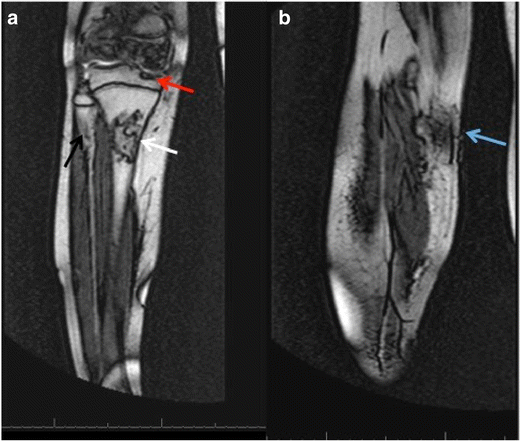 Copa Syndrome: A Novel Autosomal Dominant Immune Dysregulatory Disease ...