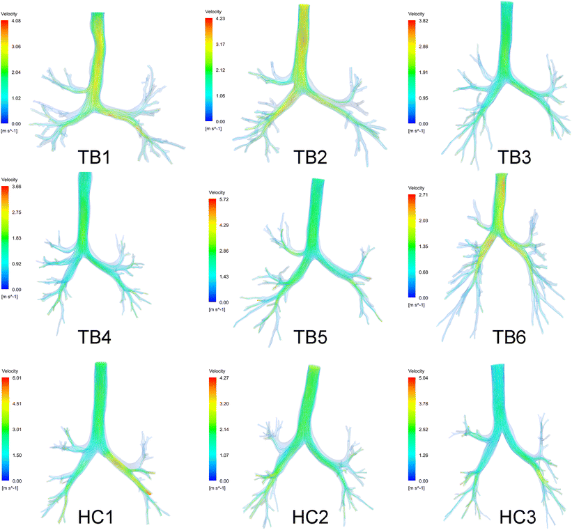 Airflow in Tracheobronchial Tree of Subjects with Tracheal Bronchus