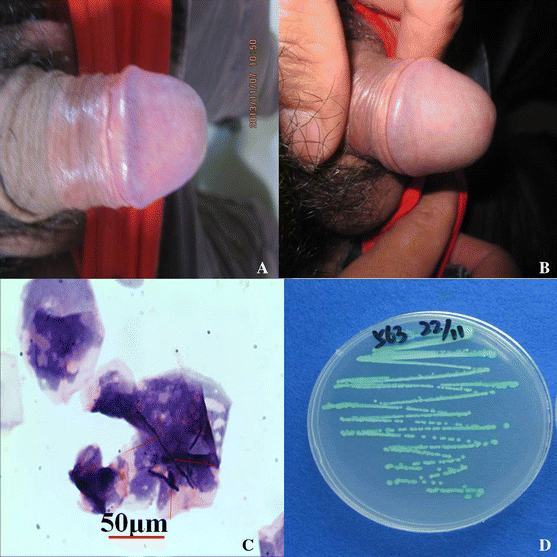 Fungus on the penis 8