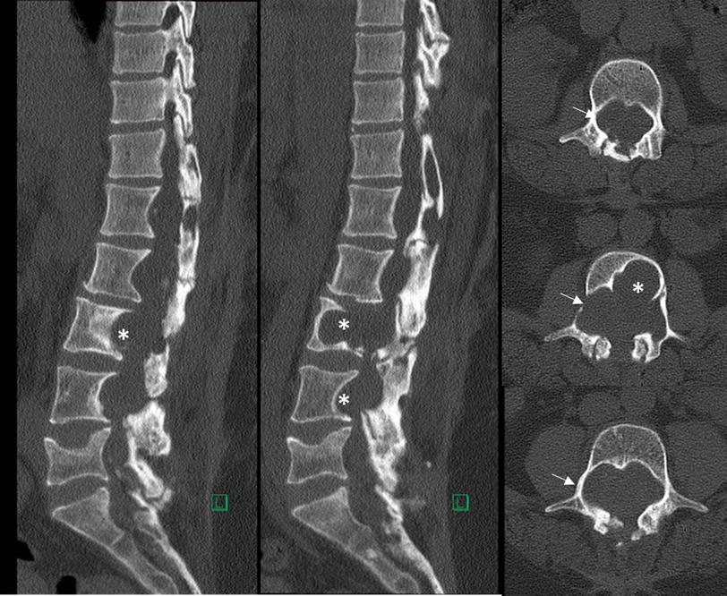 Extensive vertebral scalloping in a case of giant cystic spinal