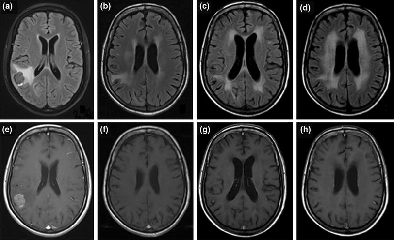 Delayed leukoencephalopathy of nonsmall cell lung cancer