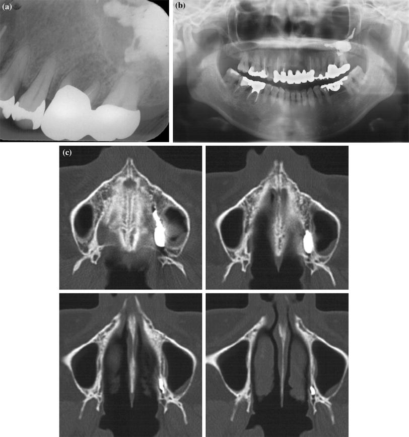 Accidental leakage of root canal filling material into the greater