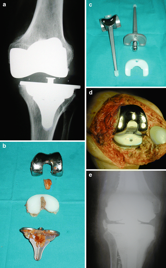 Instability Following Total Knee Arthroplasty SpringerLink